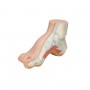 Pied Creux (Pes Cavus) 
