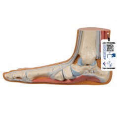 Pied Plat (Pes Planus) 