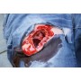 Moulage de contrôle des hémorragies