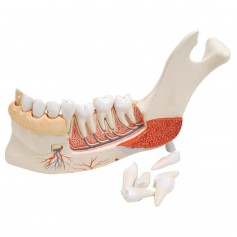 Hémi-mandibule, avec 8 dents cariées, en 19 parties