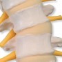 Colonne vertébrale flexible avec disques intervertébraux mou 