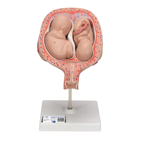 Foetus jumeaux à 5 mois, position normale