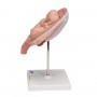 Foetus jumeaux à 5 mois, position normale 