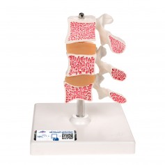 Modèle d'ostéoporose de luxe (3 vertèbres)