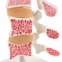 Modèle d'ostéoporose de luxe (3 vertèbres) 