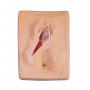 Suture post-épisiotomie, 3 pièces 