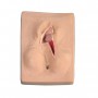 Suture post-épisiotomie, 3 pièces 