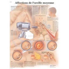 Affections de l'oreille moyenne 