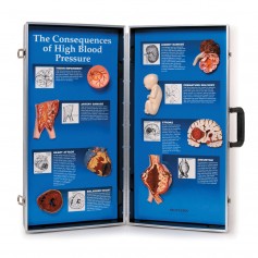 Les conséquences de l'hypertension artérielle panneau 3D