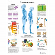 Planche anatomique L' ostéoporose