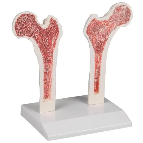 Chart Osteoporosis, 50x70cm
