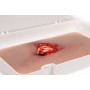 Fracture ouverte, jambe avec fonction de saignement