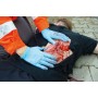 Déchirure lacérée, grande avec fonction de saignement