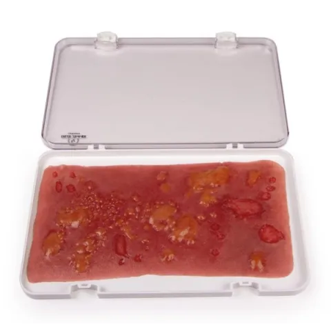 Peau brûlée au second degré, grande