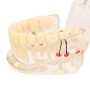 Modèle Transparent de la Mâchoire avec Dents Adultes