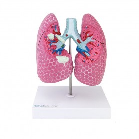 Modèle pulmonaire avec maladies
