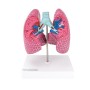 Modèle pulmonaire avec maladies