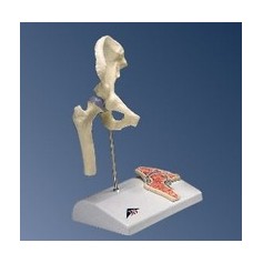 Mini-articulation de la hanche avec coupe transversale