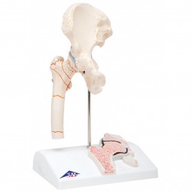 Fracture du fémur et usure de l'articulation de la hanche 