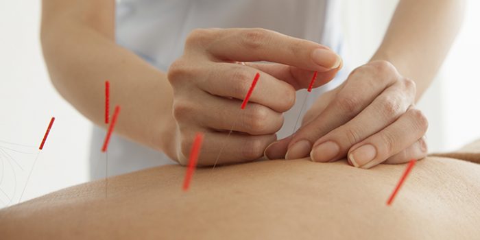 Acupuncture