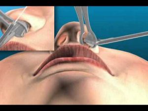 spéculum nasal
