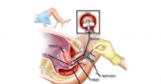 spéculum vaginal