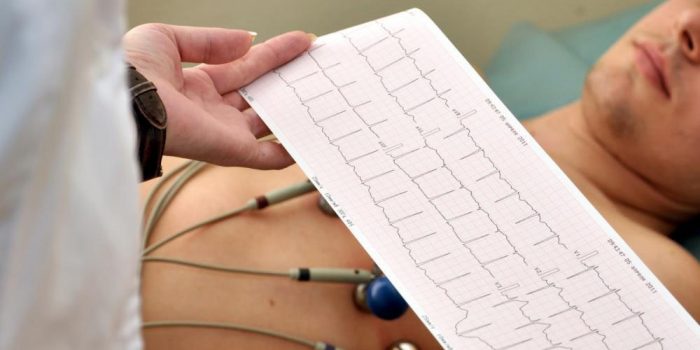 L'électrocardiogramme  ou ECG